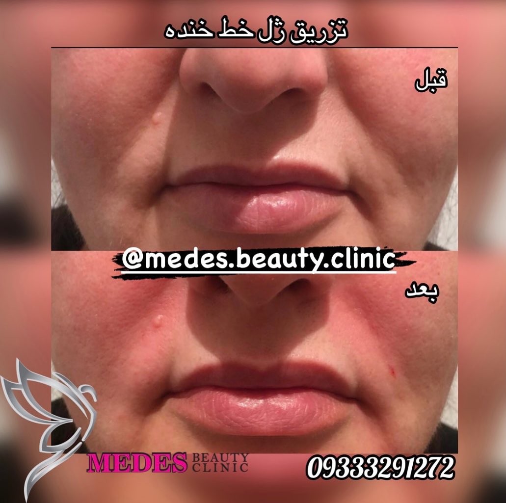 تزریق ژل خط خنده